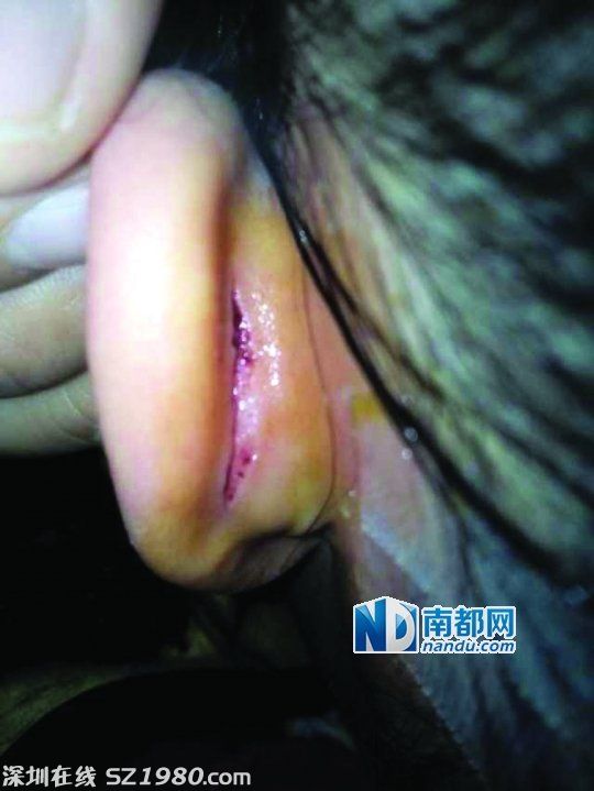 東莞6歲女童被幼師扯裂耳朵 血口長(zhǎng)4厘米(圖)