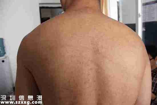 2013年4月22日，王志剛被轉送到劍閣縣看守所，重新檢查了身體狀況。照片顯示，王志剛的后背有條狀色素沉著。