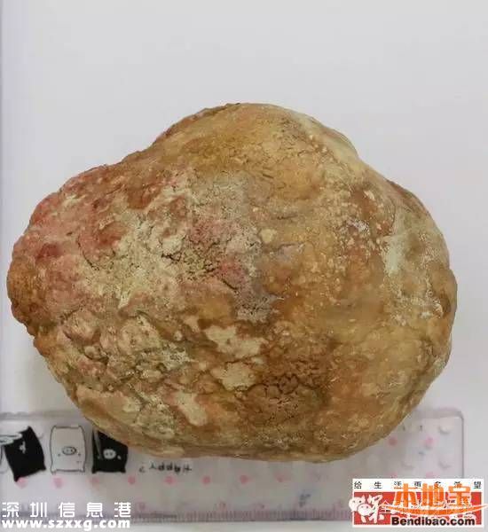 膀胱取出巨大結(jié)石 一斤重占滿(mǎn)整個(gè)膀胱