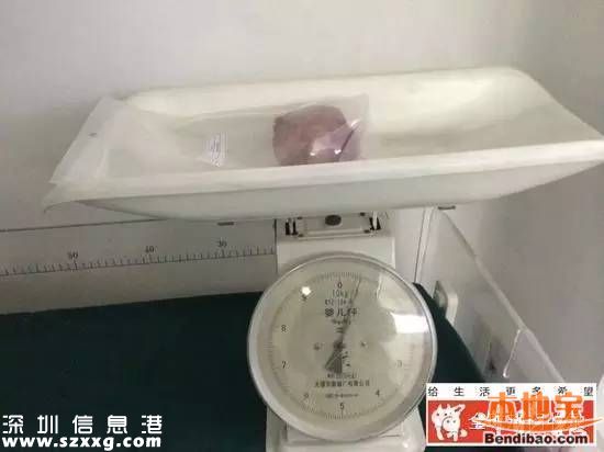 膀胱取出巨大結(jié)石 一斤重占滿(mǎn)整個(gè)膀胱