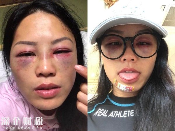 女星錄節(jié)目被暴打 只見臉上紅腫嚇人險些被毀容