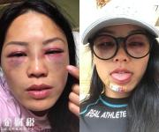節(jié)目被暴打 只見(jiàn)臉上紅腫嚇人險(xiǎn)些被毀容